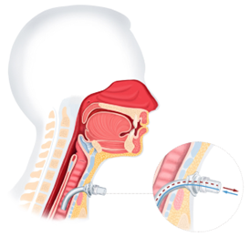 Tracheostomie afbeelding 2